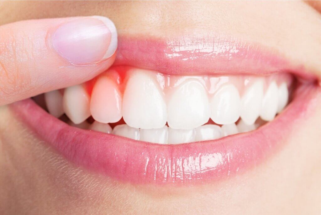 Diş Eti Hastalıkları ve Tedavisi