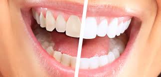 Pursaklar Bonding Tedavisi Tavsiyesi